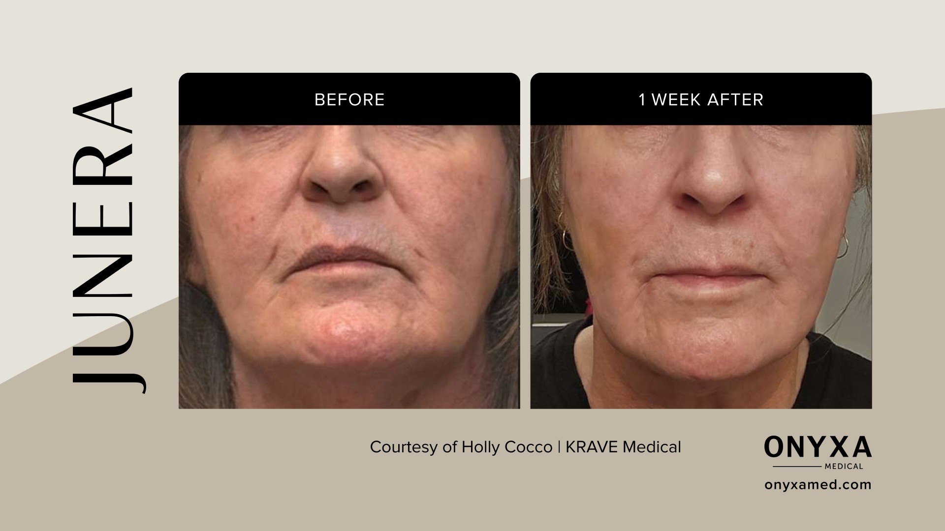 Submental - Submental definition, 6 weeks post-treatment