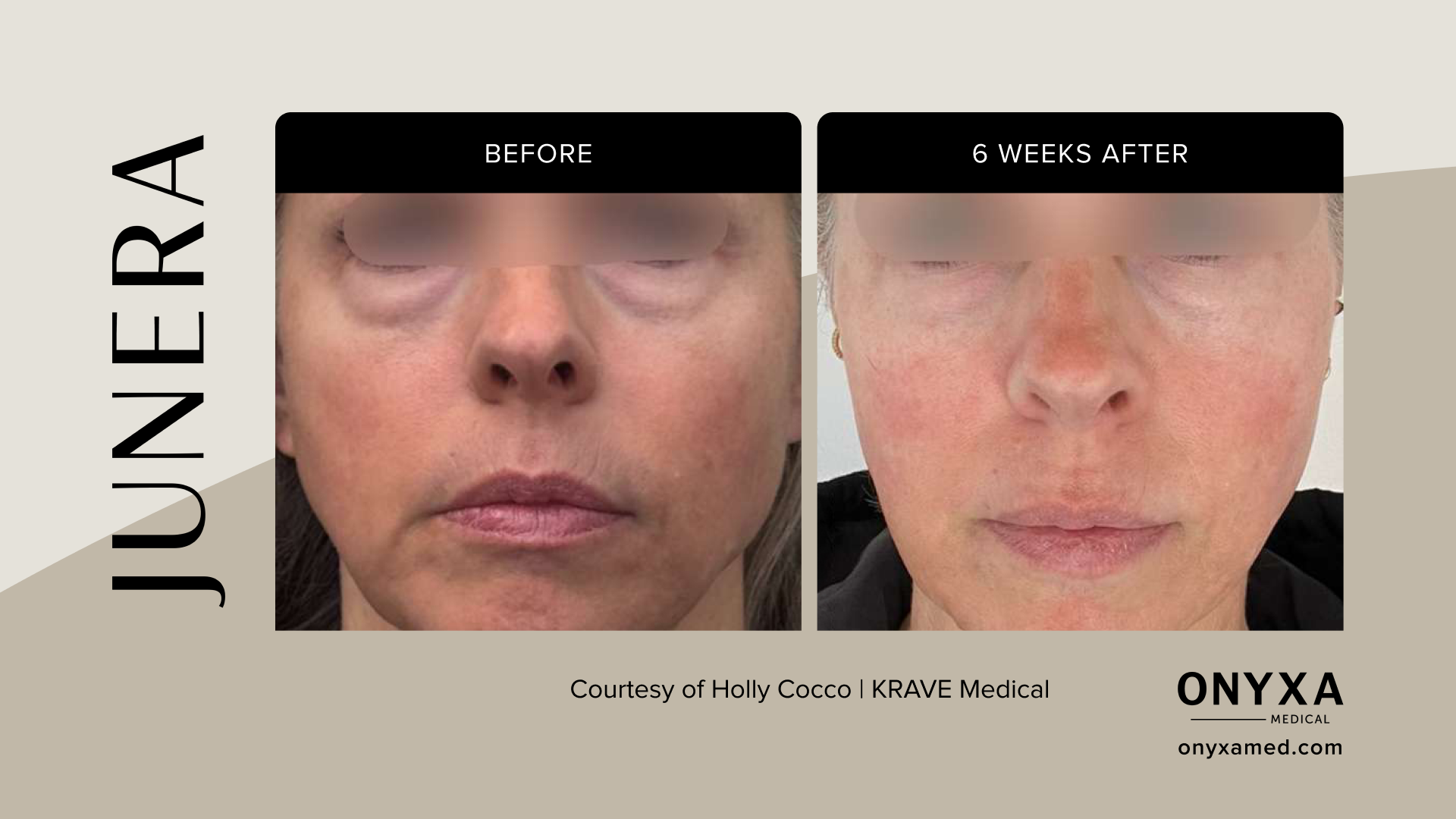 Jawline - Jawline refinement, 4 weeks post-treatment