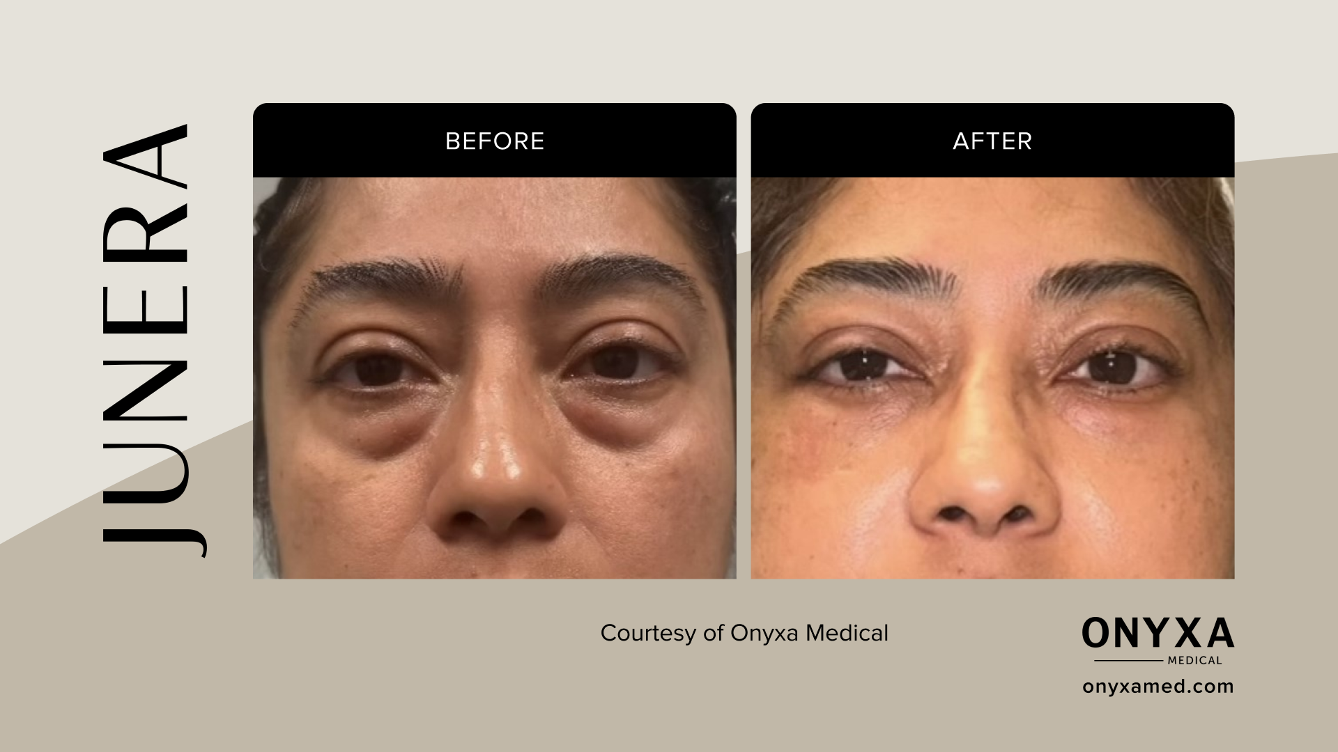 Submental - Submental contouring, 4 weeks post-treatment