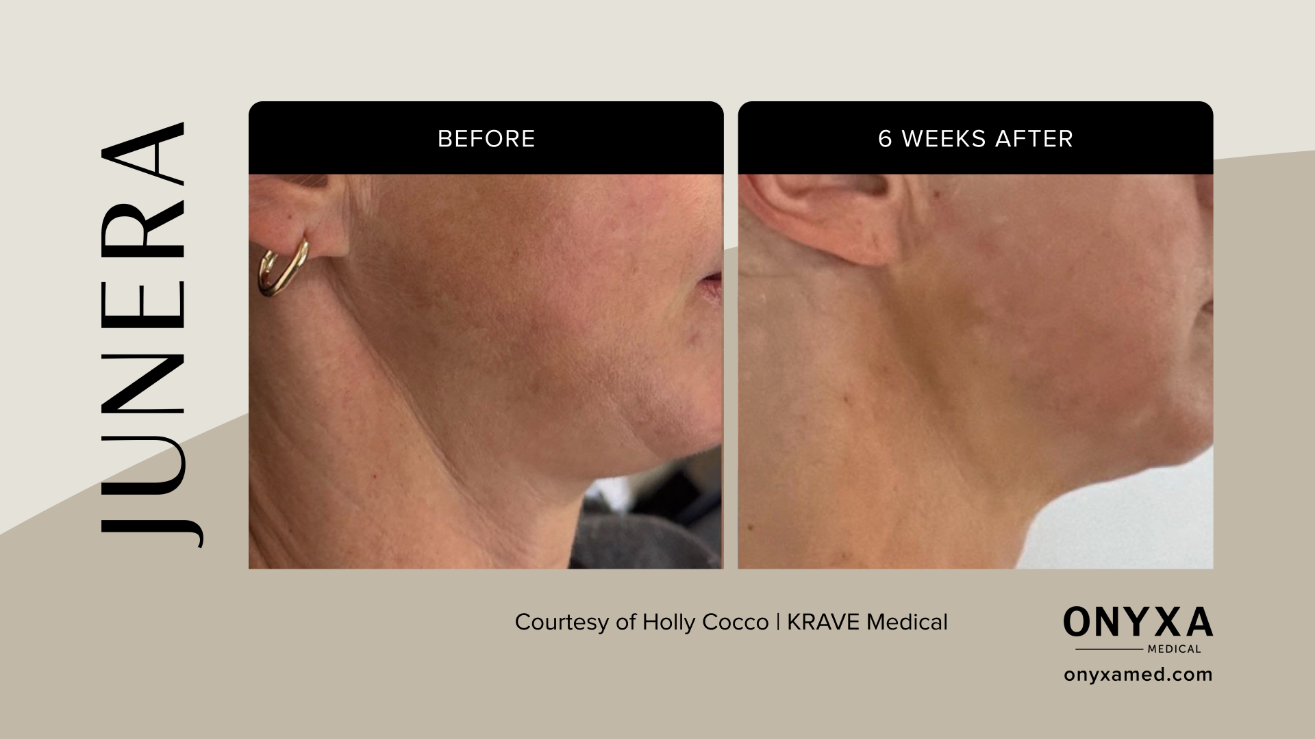 Full Face - Full face lifting, 8 weeks post-treatment