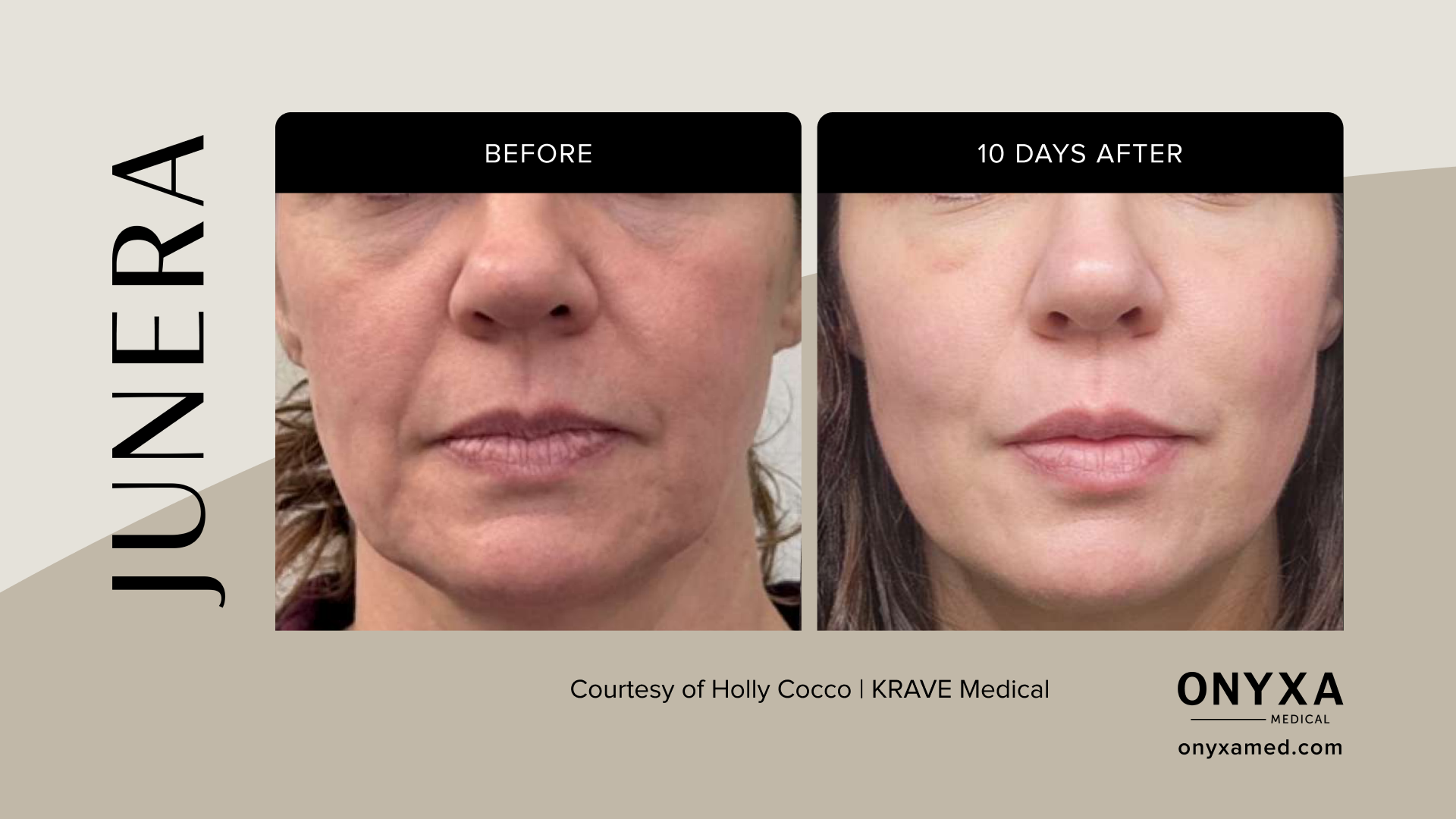Lower Face - Lower face sculpting, 6 weeks post-treatment