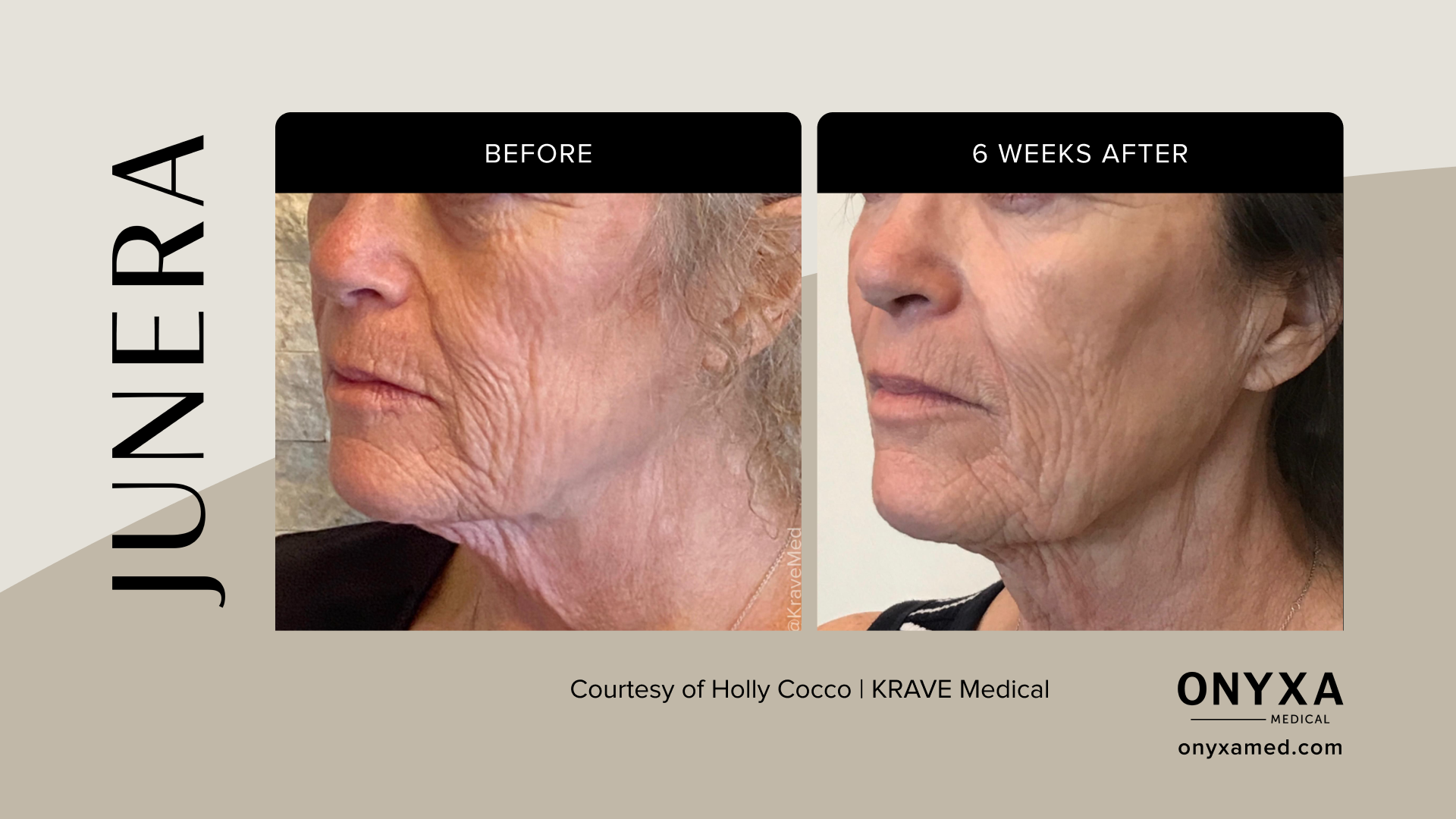 Neck - Neck rejuvenation, 4 weeks post-treatment