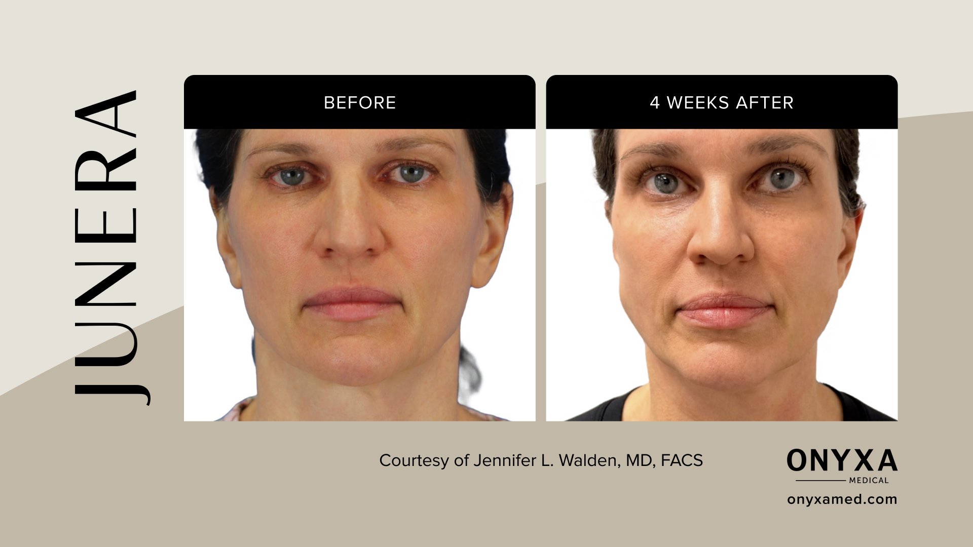 Jawline - Jawline contouring, immediately post-treatment