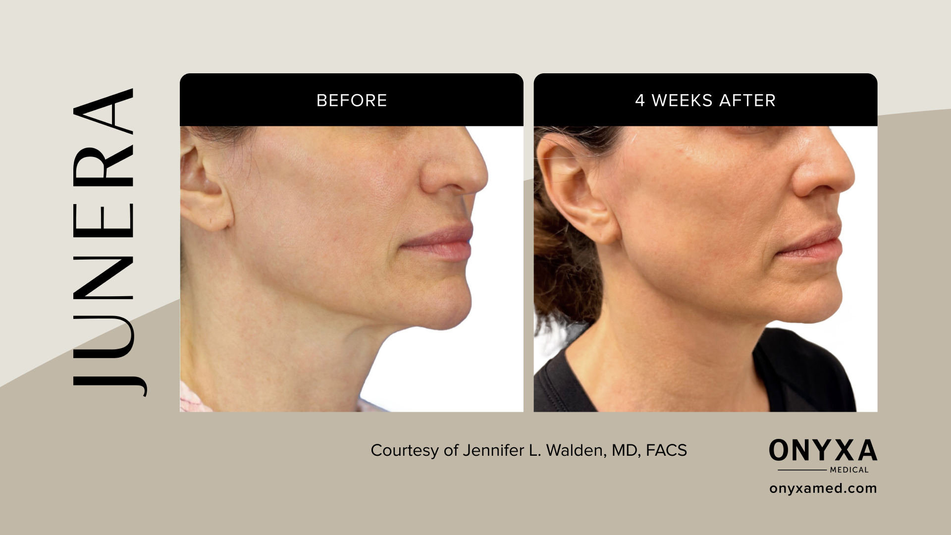 Full Face - Full face definition, 4 weeks post-treatment