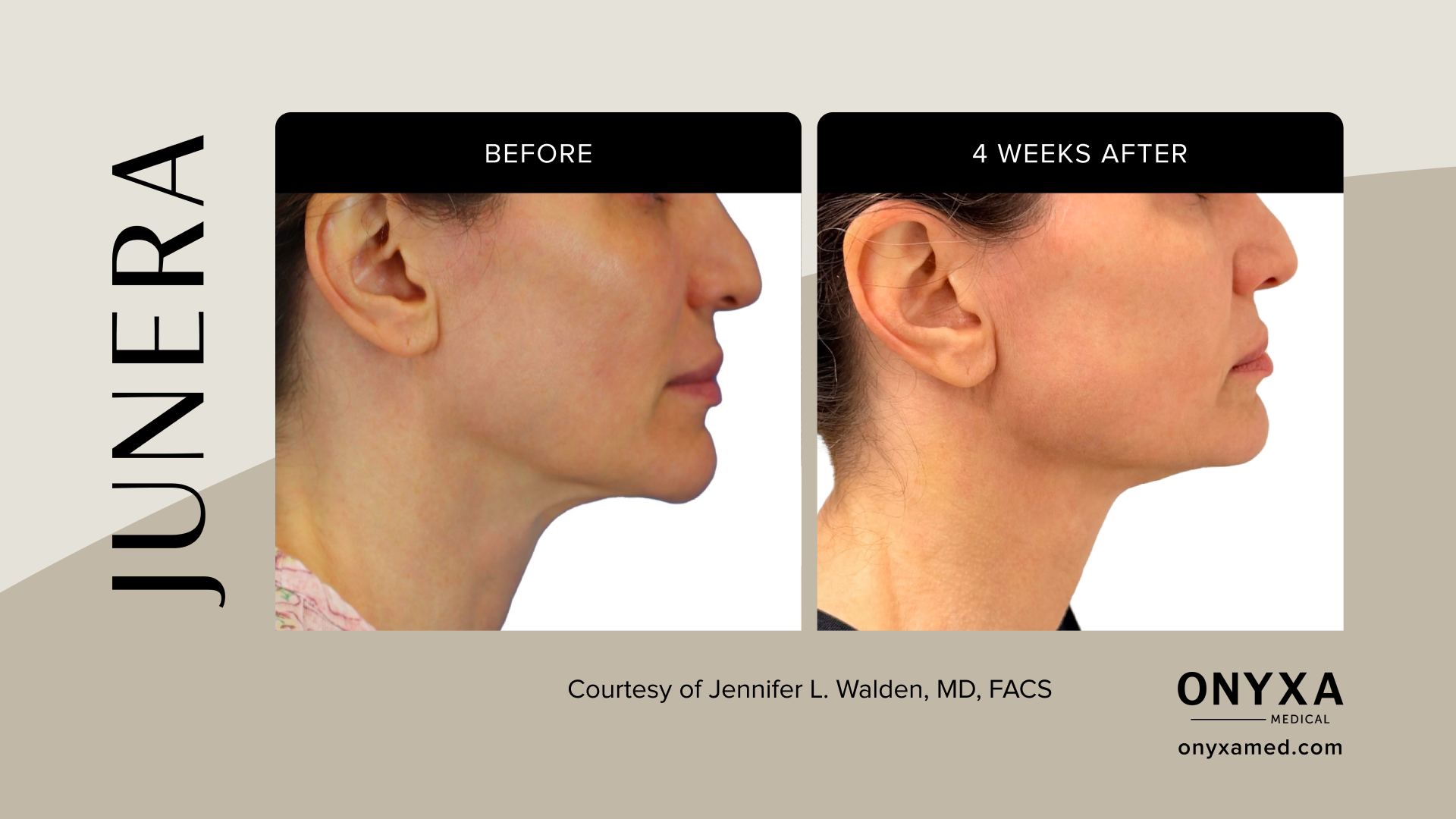 Lower Face - Lower face tightening, 6 weeks post-treatment