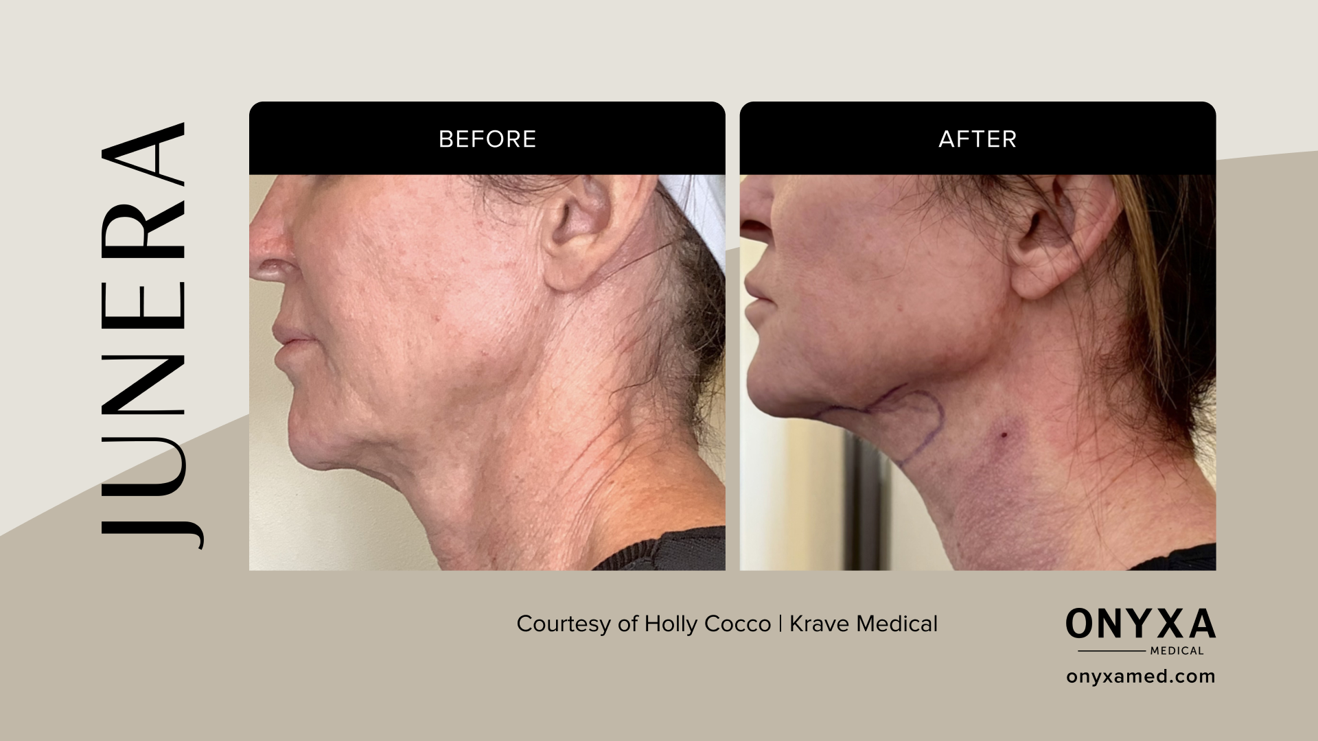 Lower Face - Lower face tightening, 8 weeks post-treatment