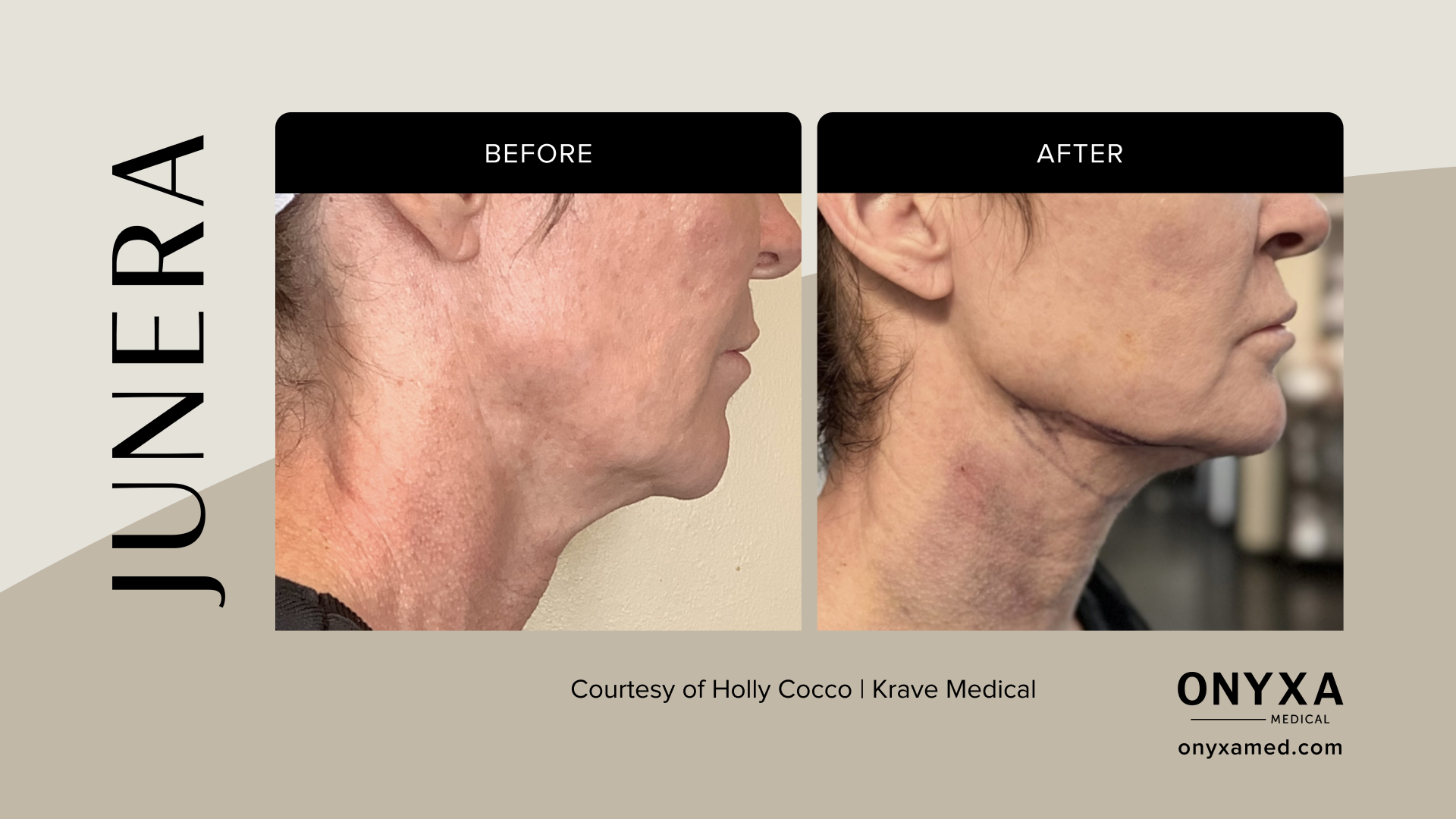 Neck - Neck laxity improvement, 6 weeks post-treatment