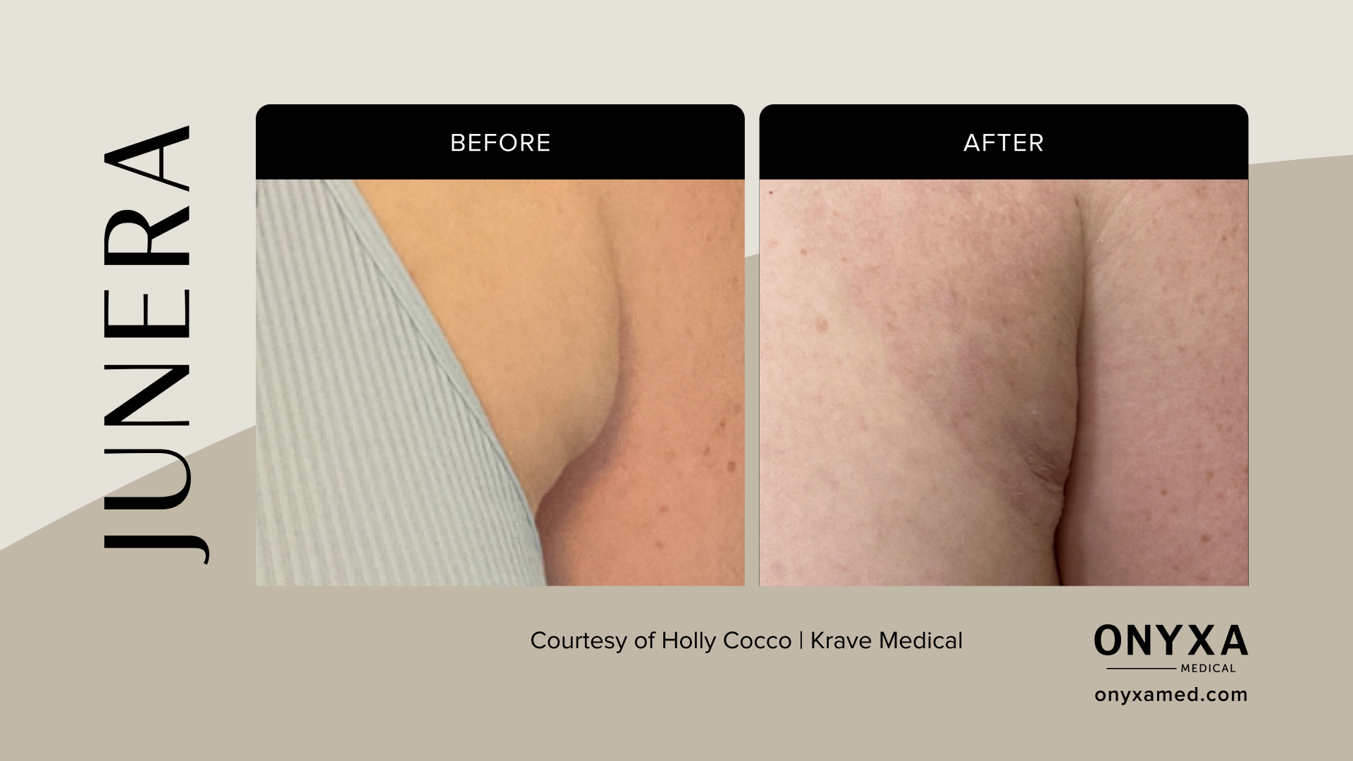 Submental - Submental fat reduction, 4 weeks post-treatment