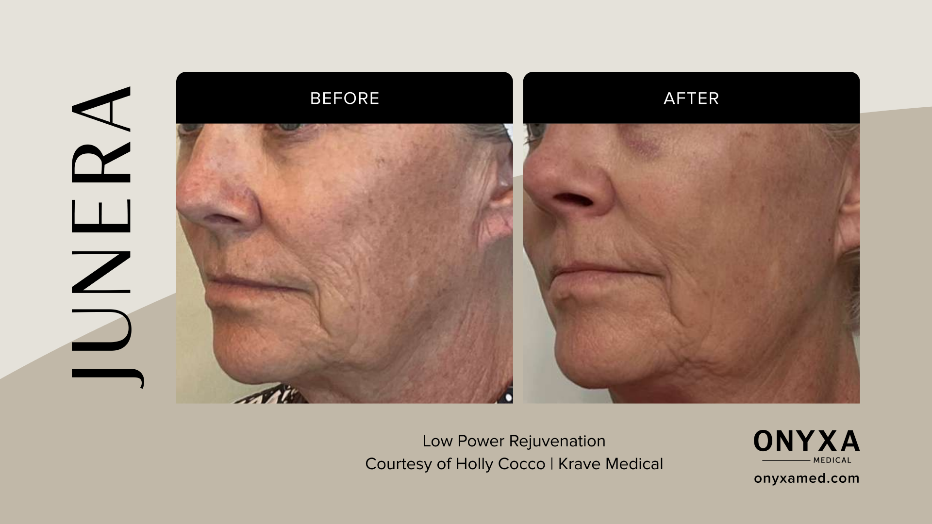 Jawline - Jawline sculpting, 8 weeks post-treatment