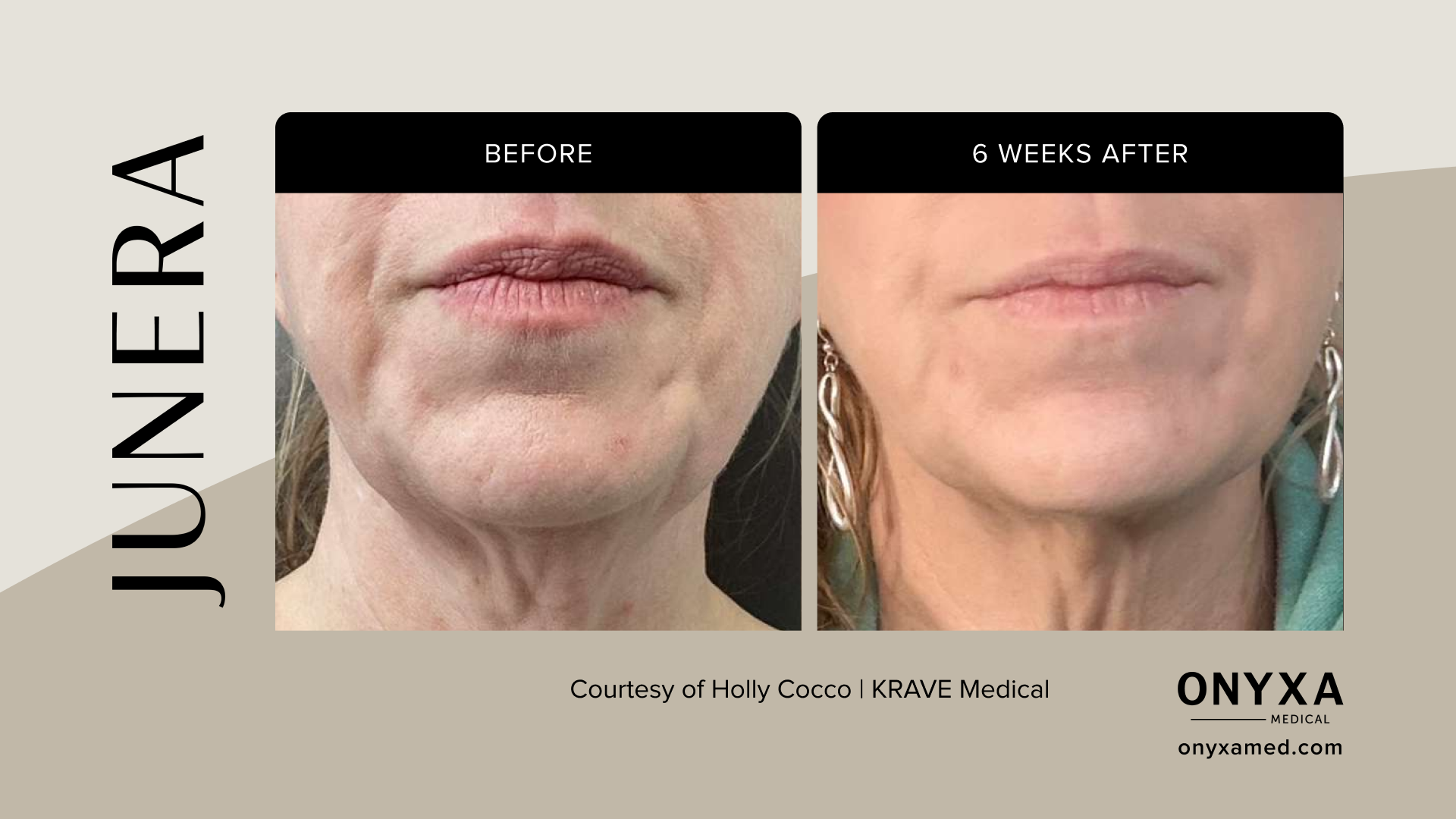 Full Face - Full face rejuvenation, 6 weeks post-treatment