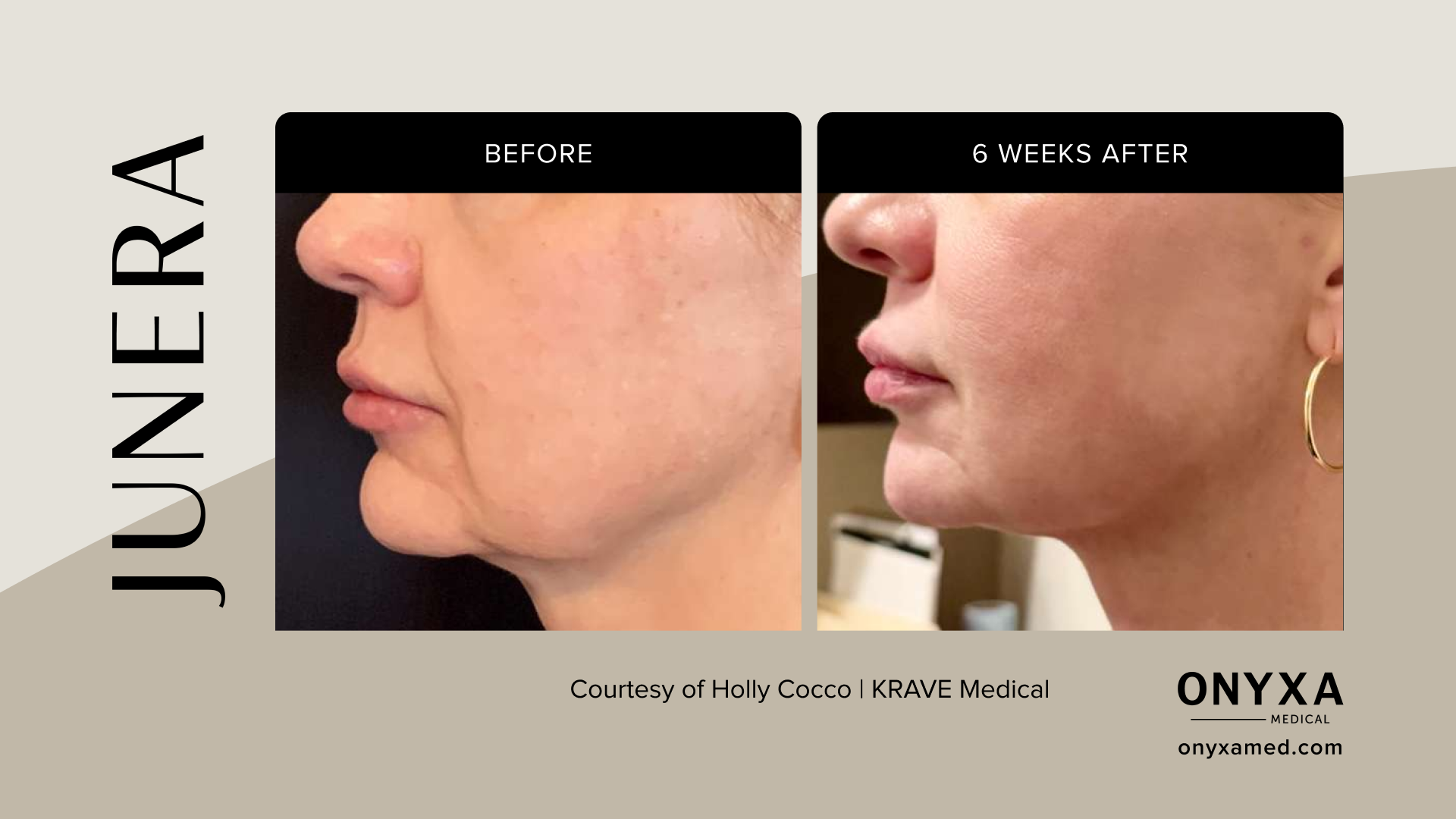 Lower Face - Lower face contouring, 4 weeks post-treatment