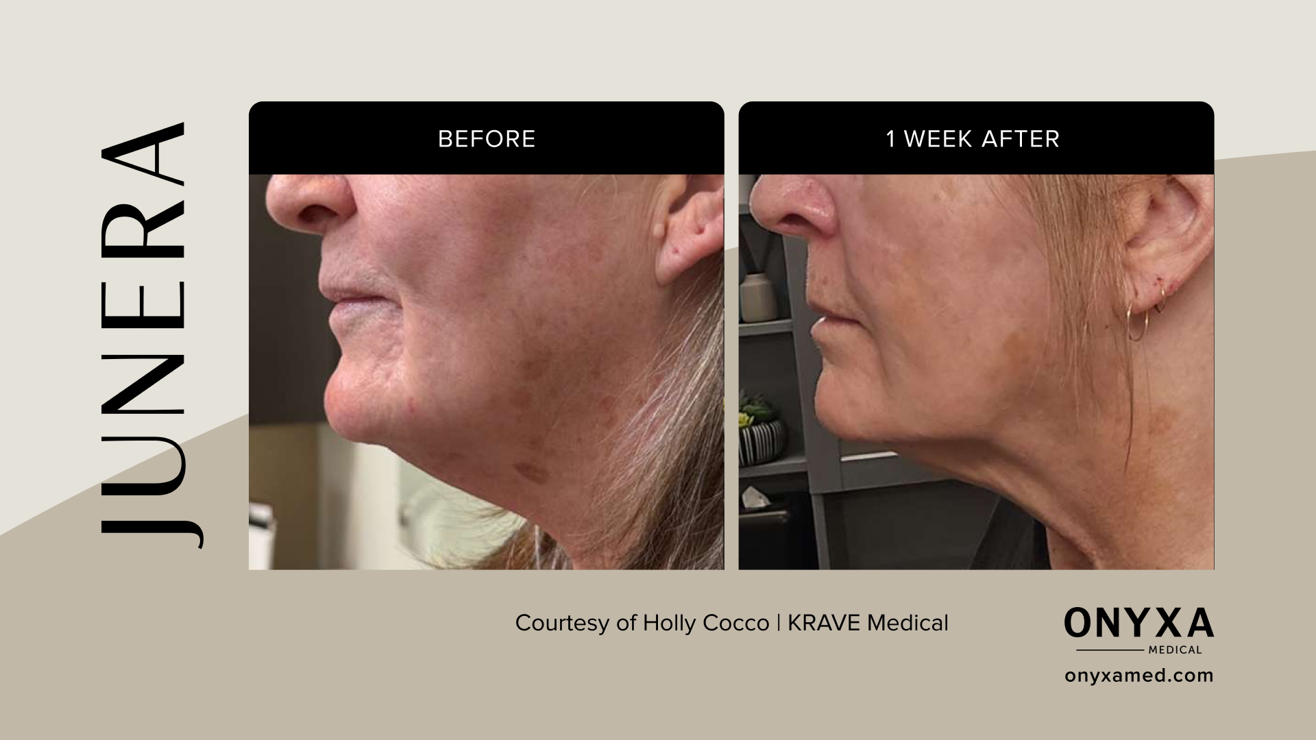 Neck - Neck tightening, 8 weeks post-treatment